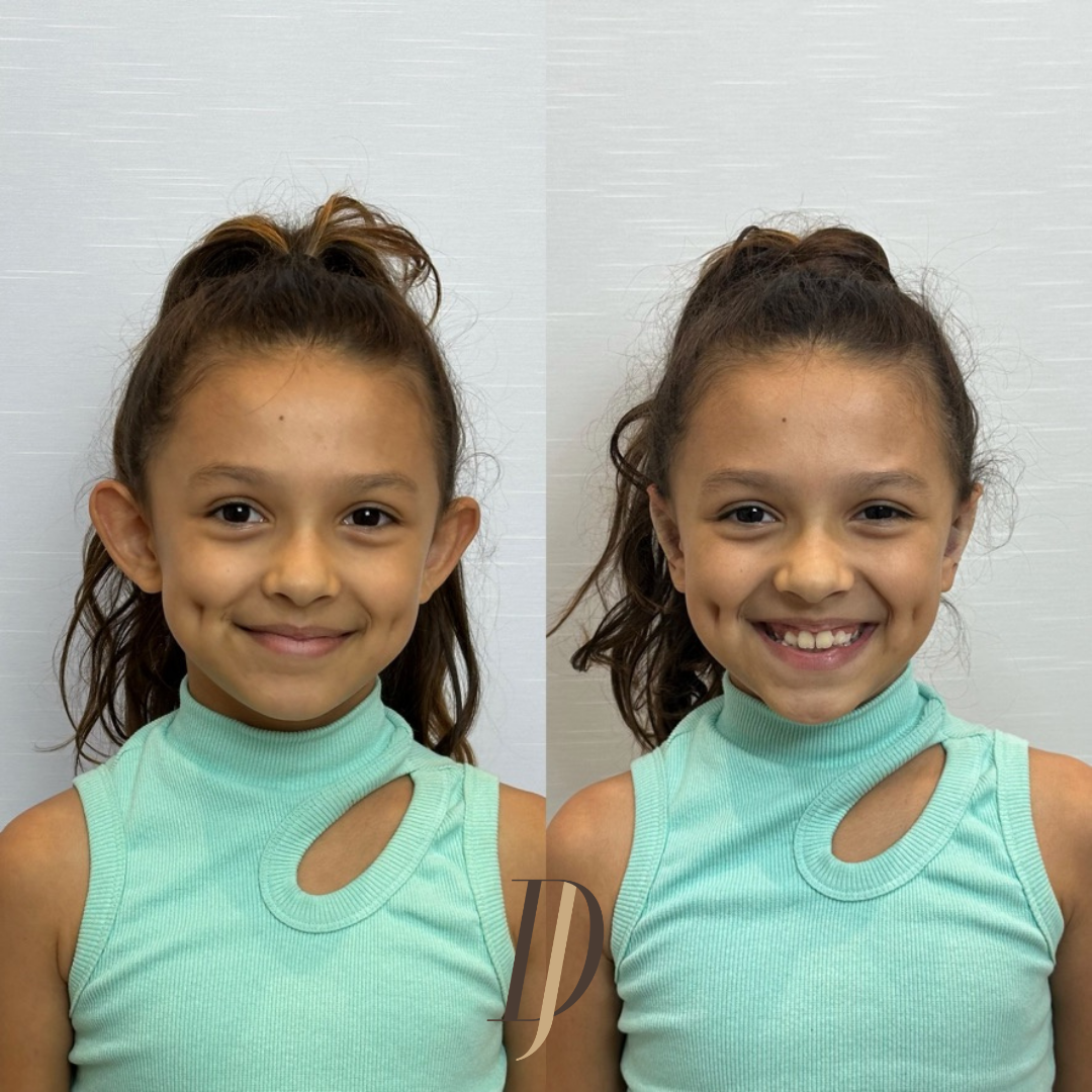 Resultado de otomodelação, antes e depois